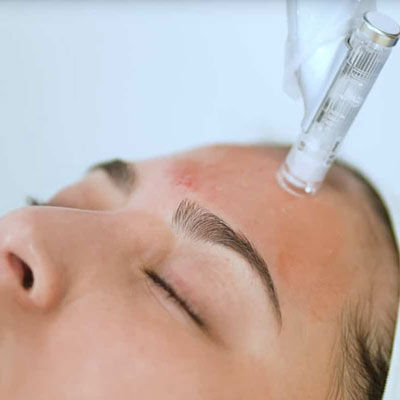 Microneedling